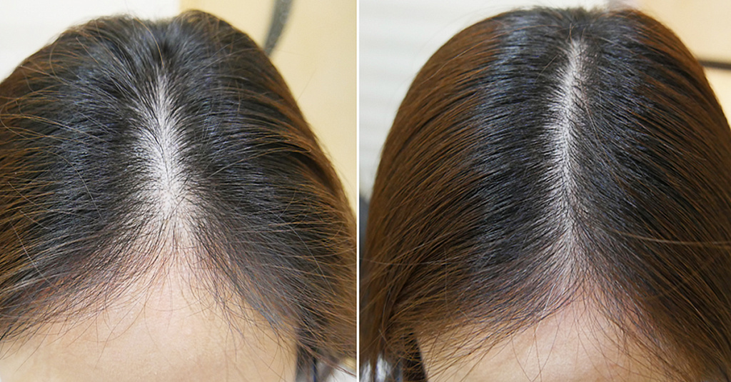 Плазмолифтинг для волос - Клиника Красоты и Здоровья